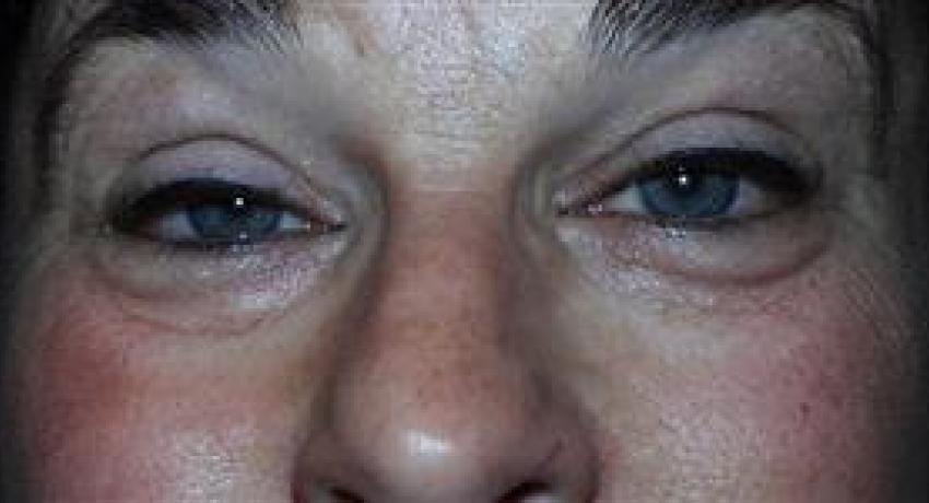 Patient with Ptosis
